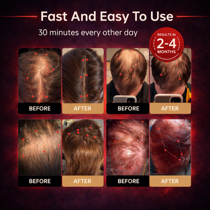 Stop Hair Thinning – Red Light Regrowth Cap
